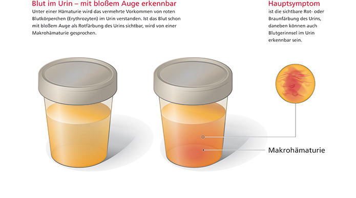 Einfache Illustration zweier Urinproben, eine davon mit sichtbarem Blut (Makrohämaturie).