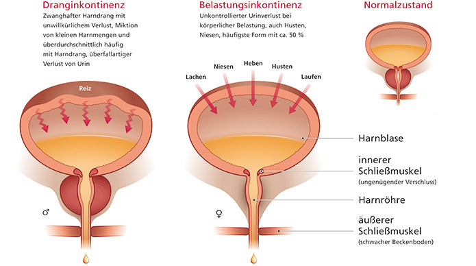 Einfache Illustration der Blase bei Dranginkontinenz und Belastungsinkontinenz sowie im Normalzustand.