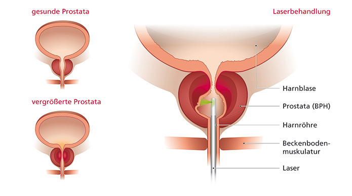 Einfache Illustration der Laserbehandlung einer Prostata im Querschnitt, einer gesunden und vergrößerten Prostata.
