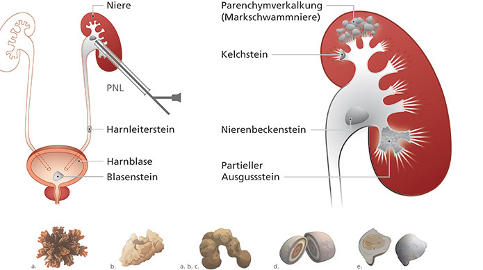 Einfache Illustration einer Niere im Querschnitt mit verschiedenen Nierensteinen und einer minimalinvasiven Behandlung.