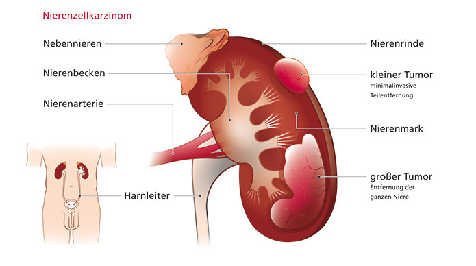 Einfache Illustration einer Niere im Querschnitt, eines Nierenzellkarzinoms und der Sitz der Niere in einem Torso.