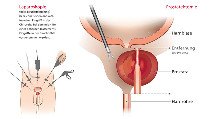 Einfache Illustration einer Prostatektomie im Querschnitt und einer laparoskopischen Behandlung.
